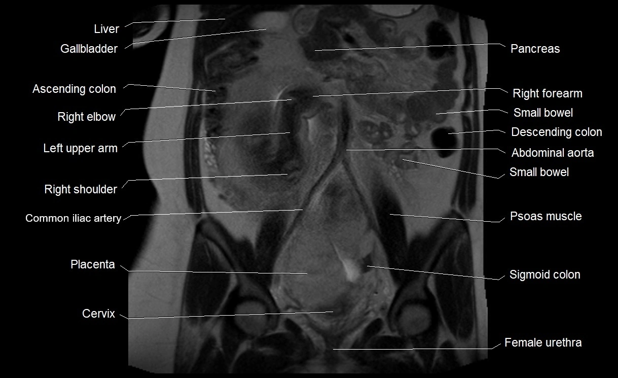 MRI Anatomy of pregnancy image 19.webp